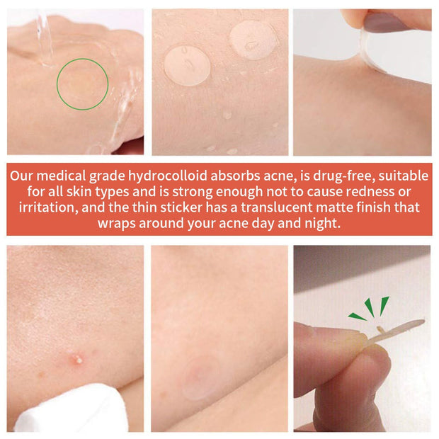 Youbuy invisible acne patch concealer acne patch acne remover without powder stuck acne patch 72 PATCHES